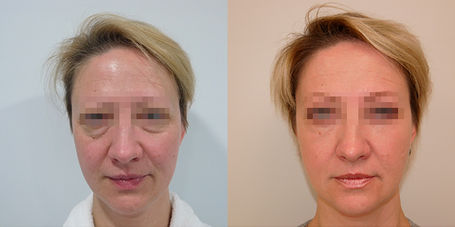 facelifting-results_03