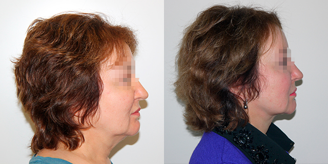 facelifting-results_05b