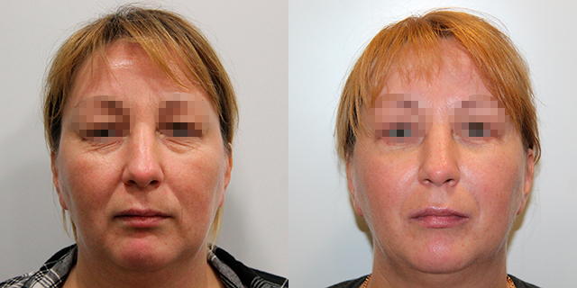 facelifting-results_06