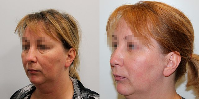 facelifting-results_06b